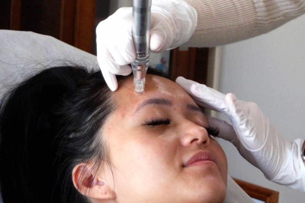 Microneedling-2-1024×1024 Microneedling-2-1024x1024